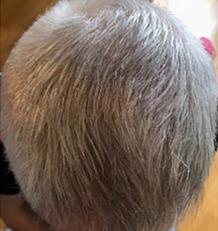 Calecim Advanced Hair System