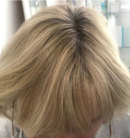 Calecim Advanced Hair System