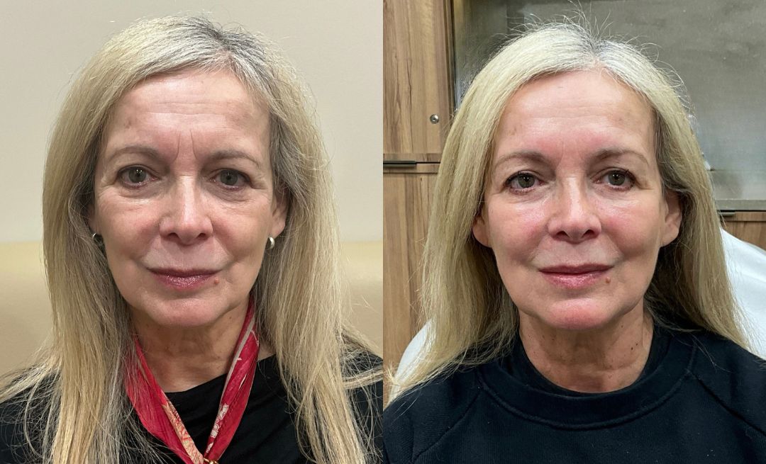 Before and after anti-wrinkle injections and dermal filler to temples, chin, jawline and marionette lines by Dr Matthew Jarvie-Thomas.