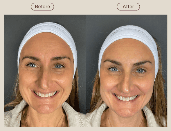 anti wrinkle injections on frown lines before and after - post summer skin