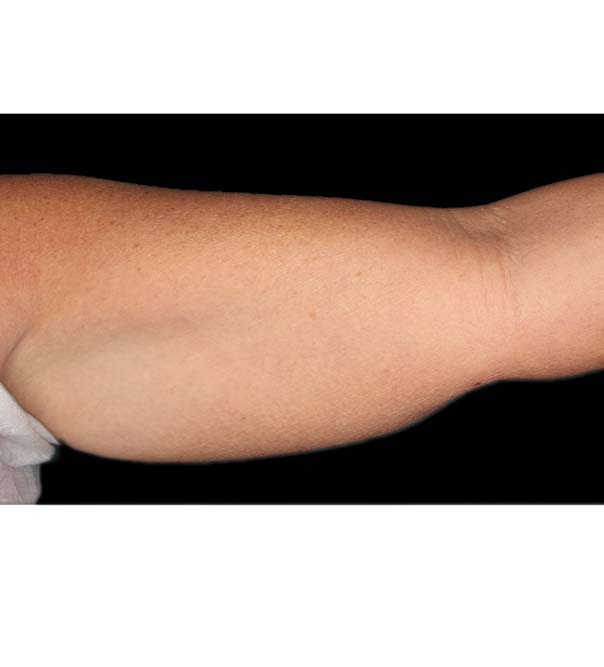 Upper arm before CoolSculpting treatment