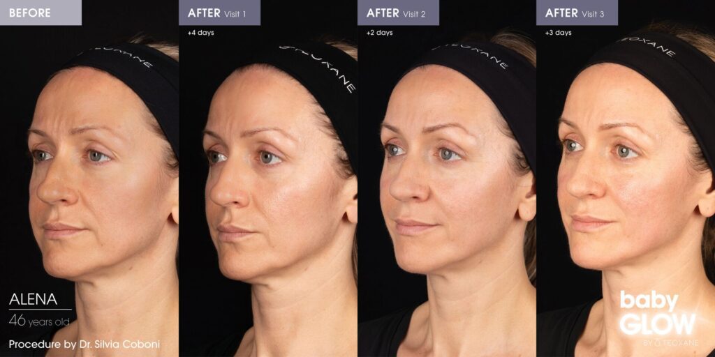 baby glow skin booster treatment before and after results - progressive skin glow
