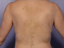 non surgical back fat removal after