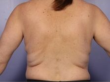 Back Fat, Lower Back Fat, Fat Freezing Back Fat Treatment in