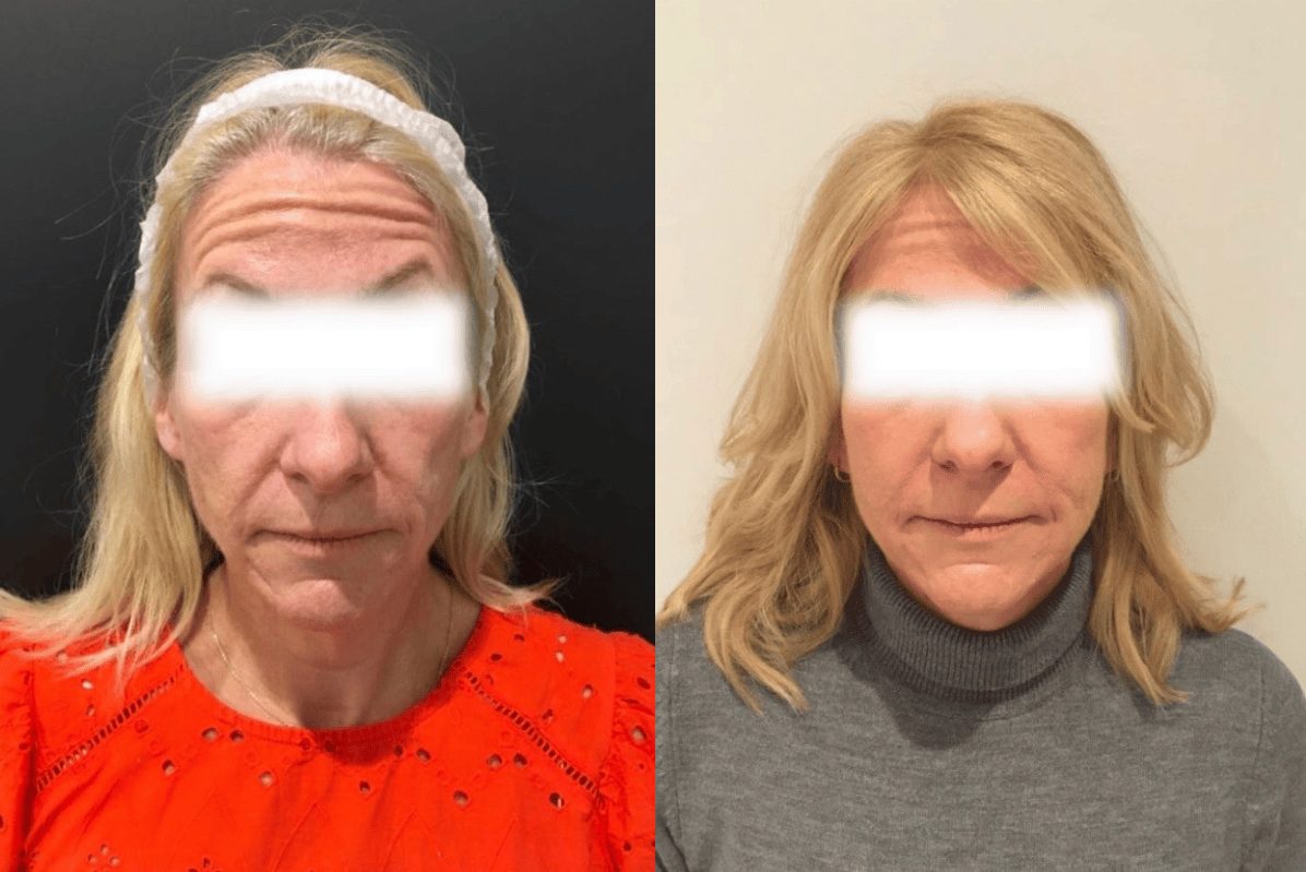 This patient had ellanse dermal fillers, results before and after treatment