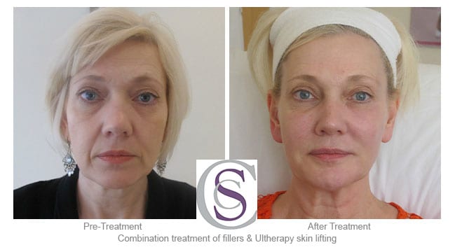 ultherapy skin lifting before and after