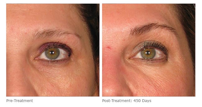 ultherapy brow lift before and after