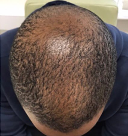 Calecim Advanced Hair System