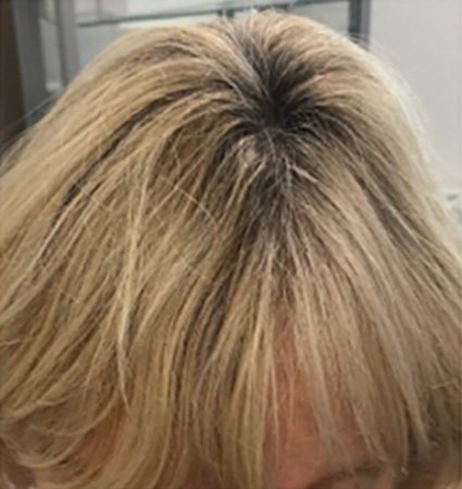 Calecim Advanced Hair System