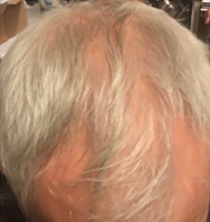 Calecim Advanced Hair System