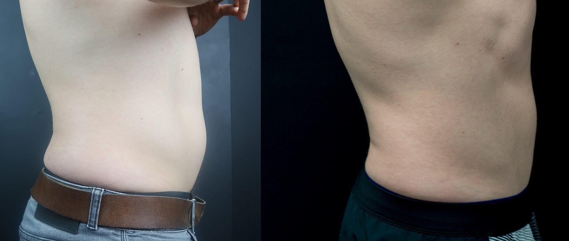 belly fat coolsculpting before and after