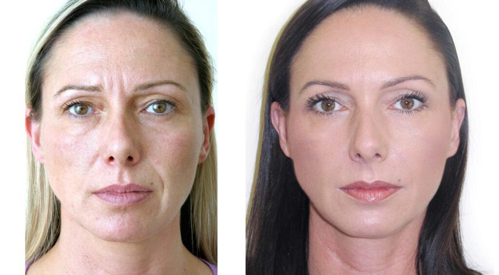 best botox in london and bucks before and after 11 lines nose to mouth lines