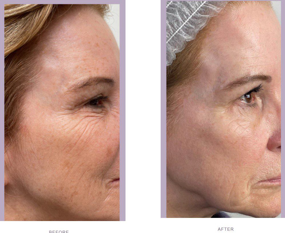 best laser treatments forever young BBL before and after