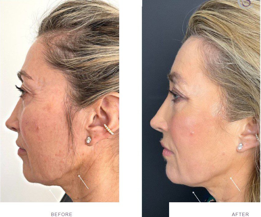 best laser treatments morpheus8 before and after