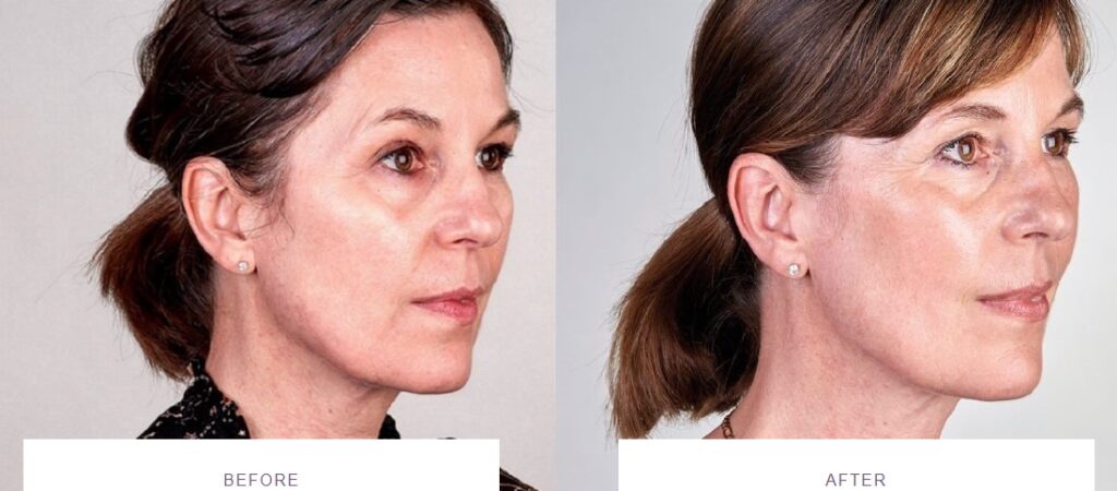 best laser treatments ultherapy before and after
