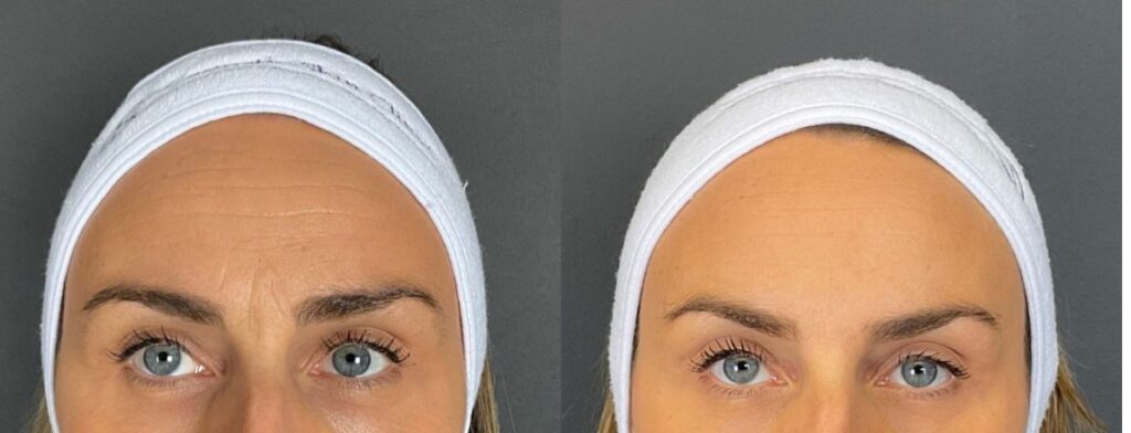 botox before and after forehead