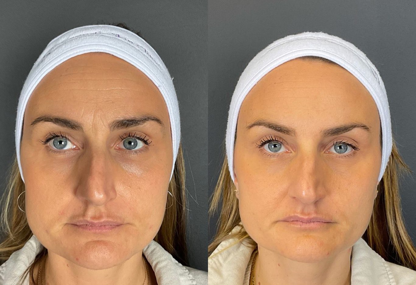 botox forehead lines frown lines before and after - By Tara Jackson