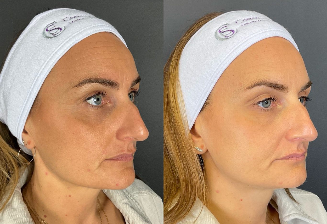 botox forehead wrinkles before and after - By Tara Jackson