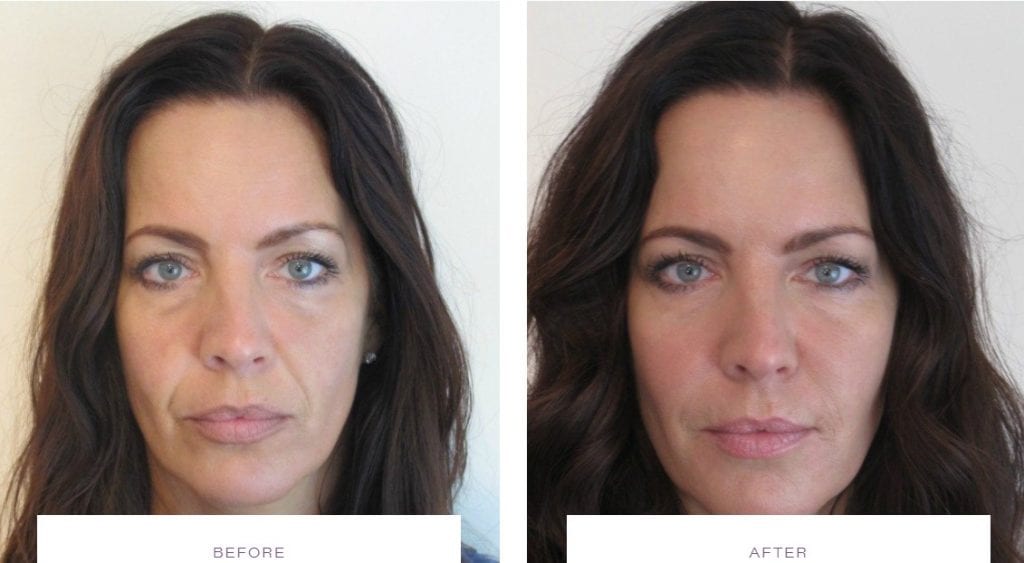botox on face areas before after