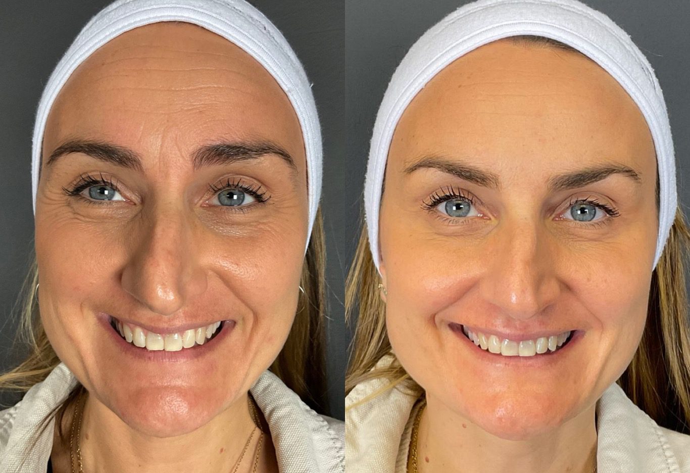 botox smile lines, botox eye wrinkles, crows feet, forehead lines botox