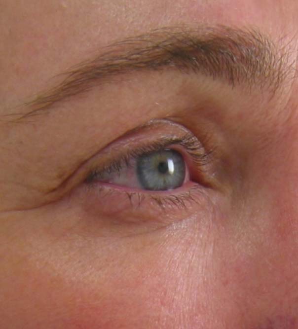 A close up of an eye following Ultherapy skin lifting and tightening