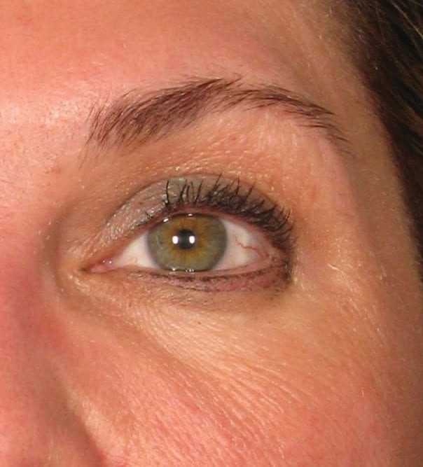 Brow Lift After Ultherapy Treatment