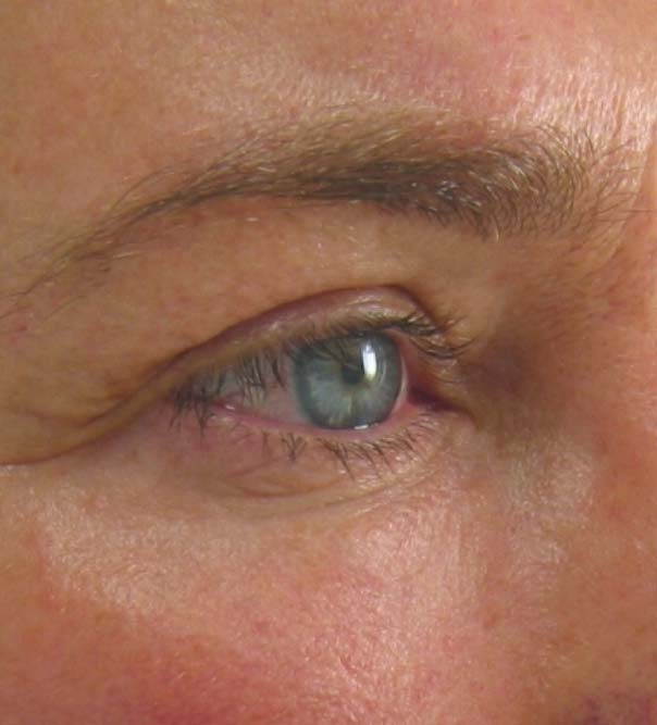 A close up of an eye before a brow lift
