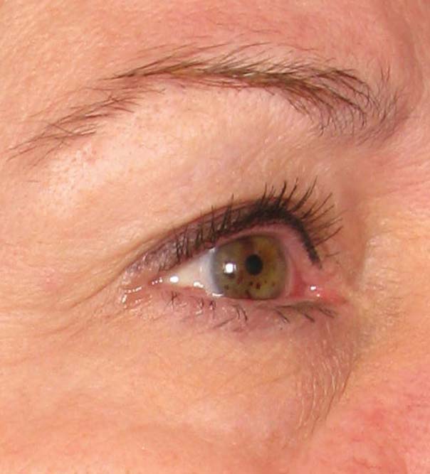 A close up of an eye after Ultherapy treatment
