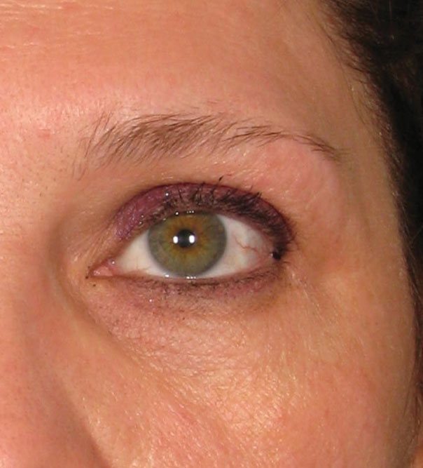 Brow lift on patient before skin tightening with ultherapy ultrasound