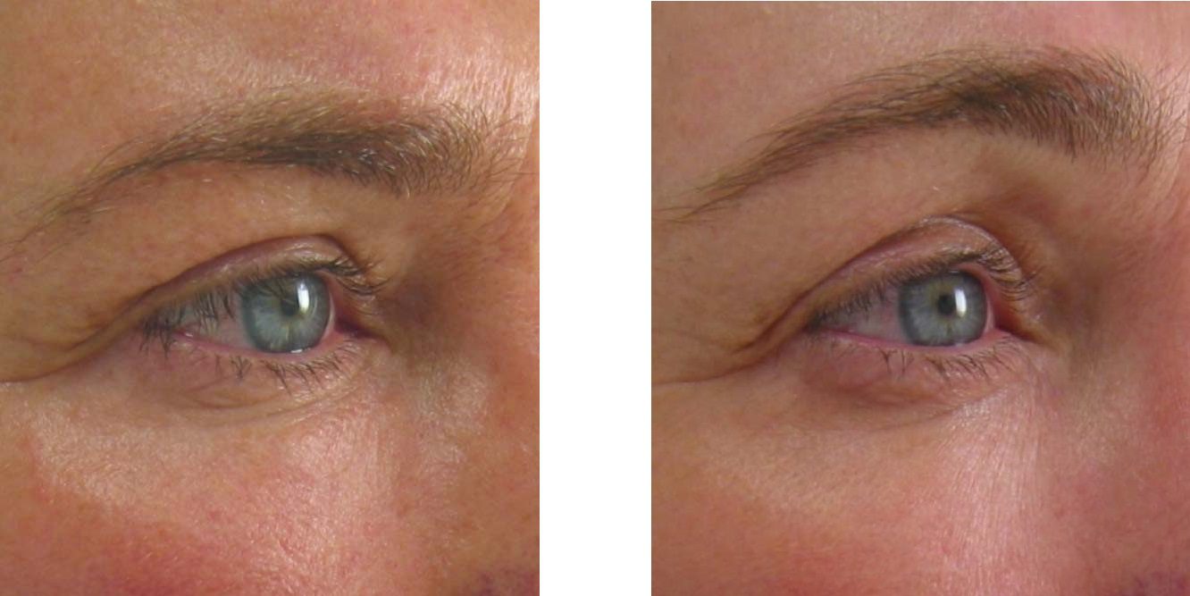 brow lift with ultherapy before and after