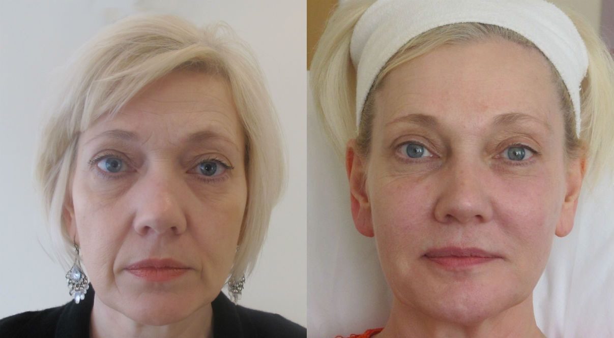 cheek filler - face contouring-before-and-after
