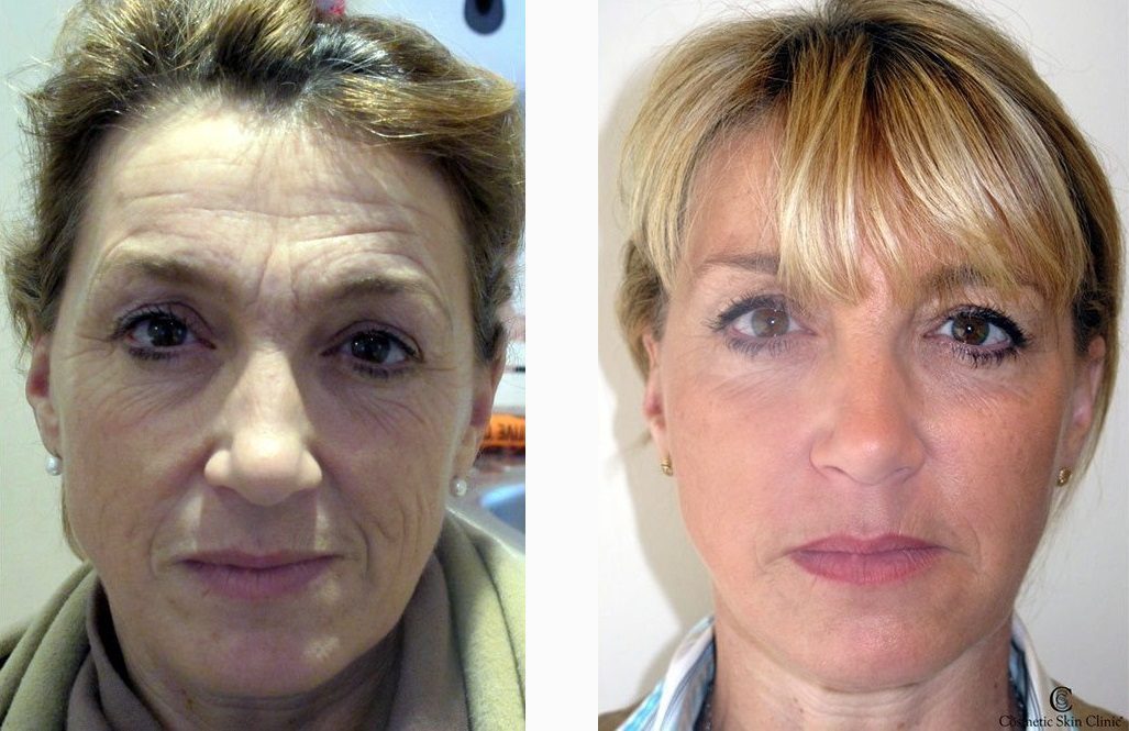 cheek filler-fine-lines-and-wrinkles-on-the-face-before-and-after