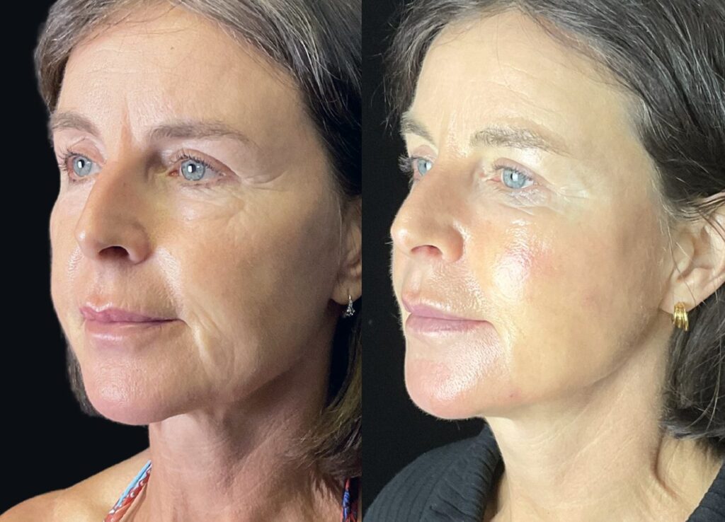 cheek filler to lift jowls before and after