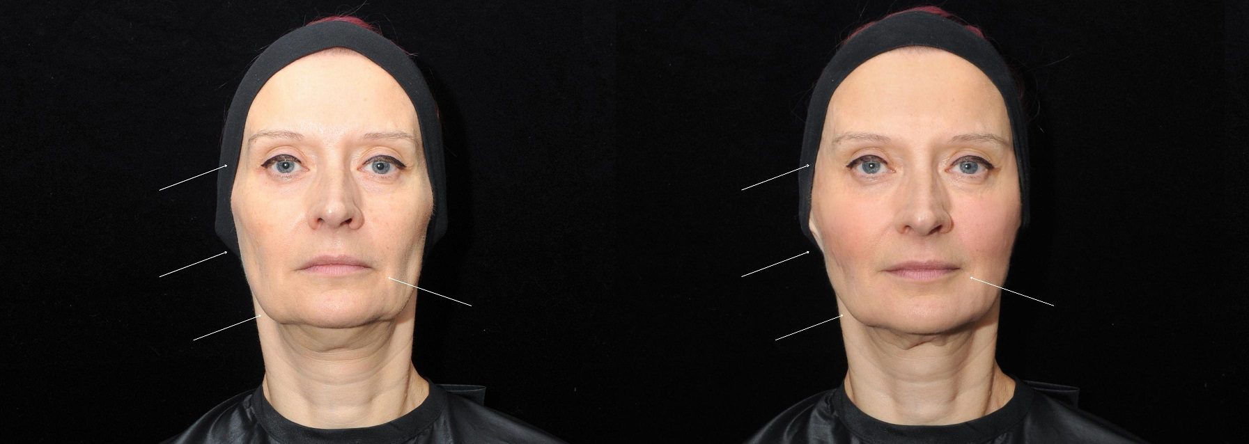 cheek fillers facial contouring before and after