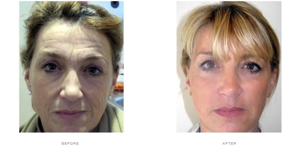 Cheek Lift Before and After