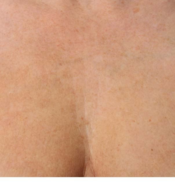 A chest close up after micro injections of Restylane Skinboosters