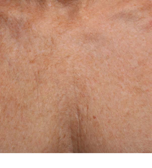 Chest skin after micro injections to smooth crepey skin