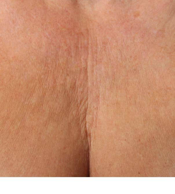 A close up of a crepey decolletage