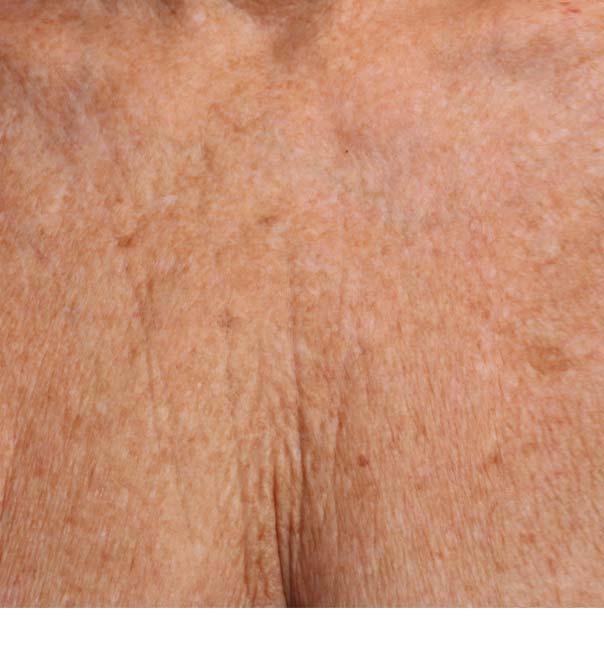 A close up of crepey chest skin before cosmetic treatment
