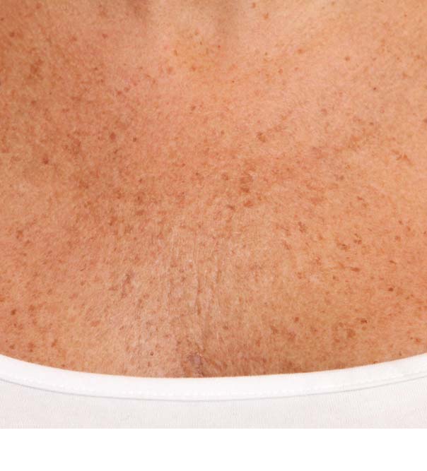 Smooth and hydrated chest skin after treatment with micro injections of Restylane