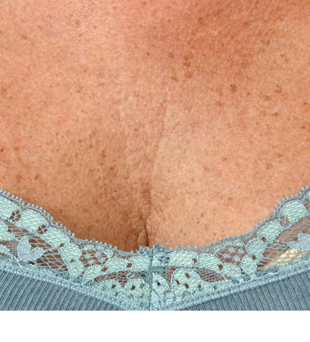 A close up of a crepey decolletage