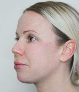 chin augmentation with ha dermal filler before