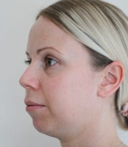 chin augmentation with ha dermal filler before