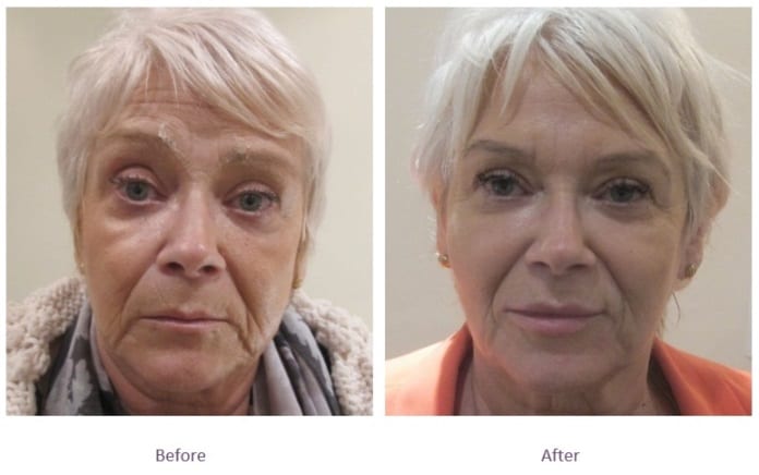 Chin filler before and after sagging skin