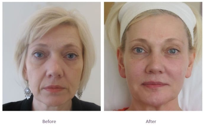 Chin filler before and after volume