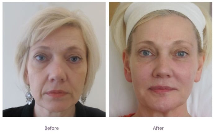 Restore skin lost volume with chin fillers Chin filler before and after volume