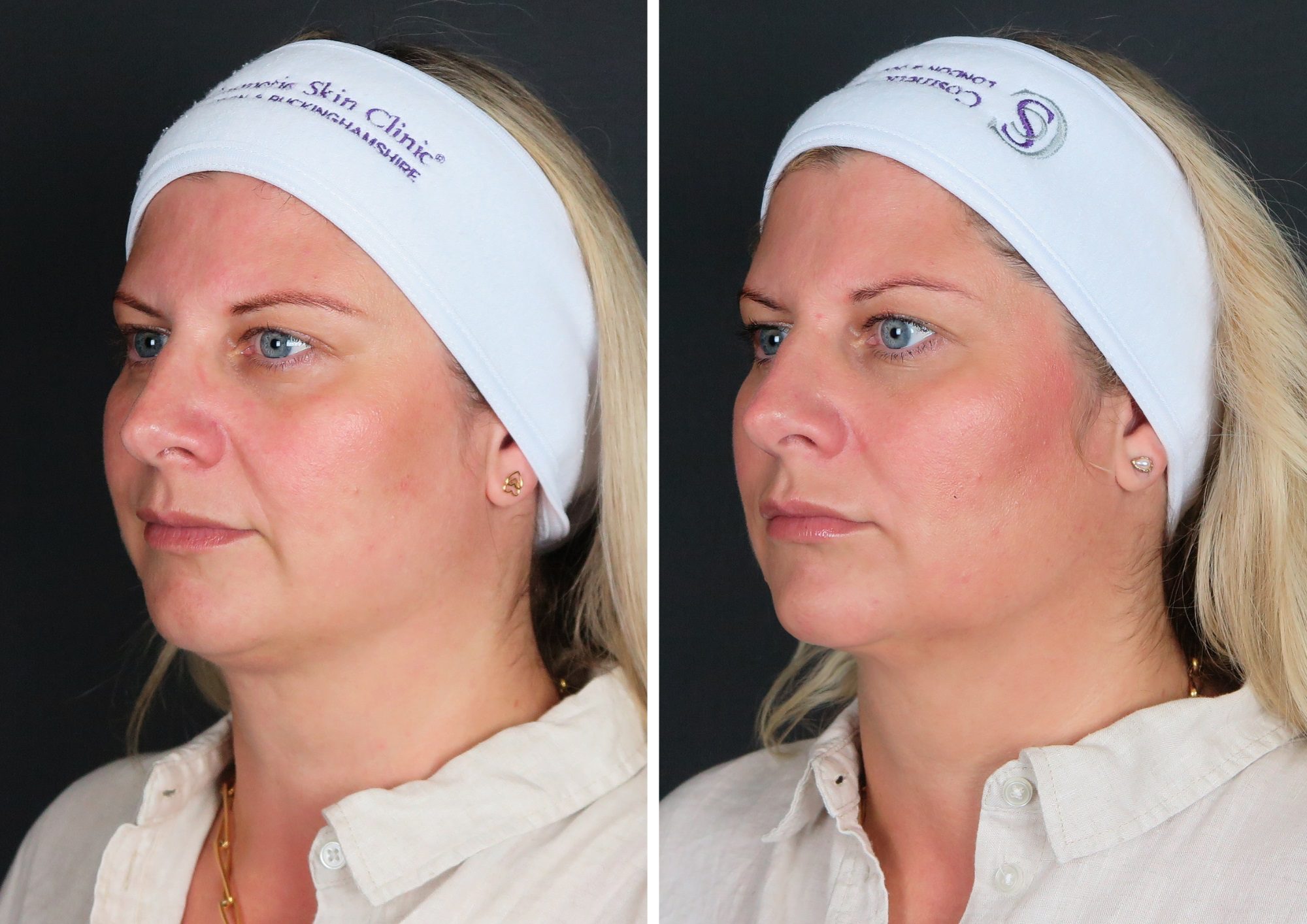 chin filler treatment before and after results