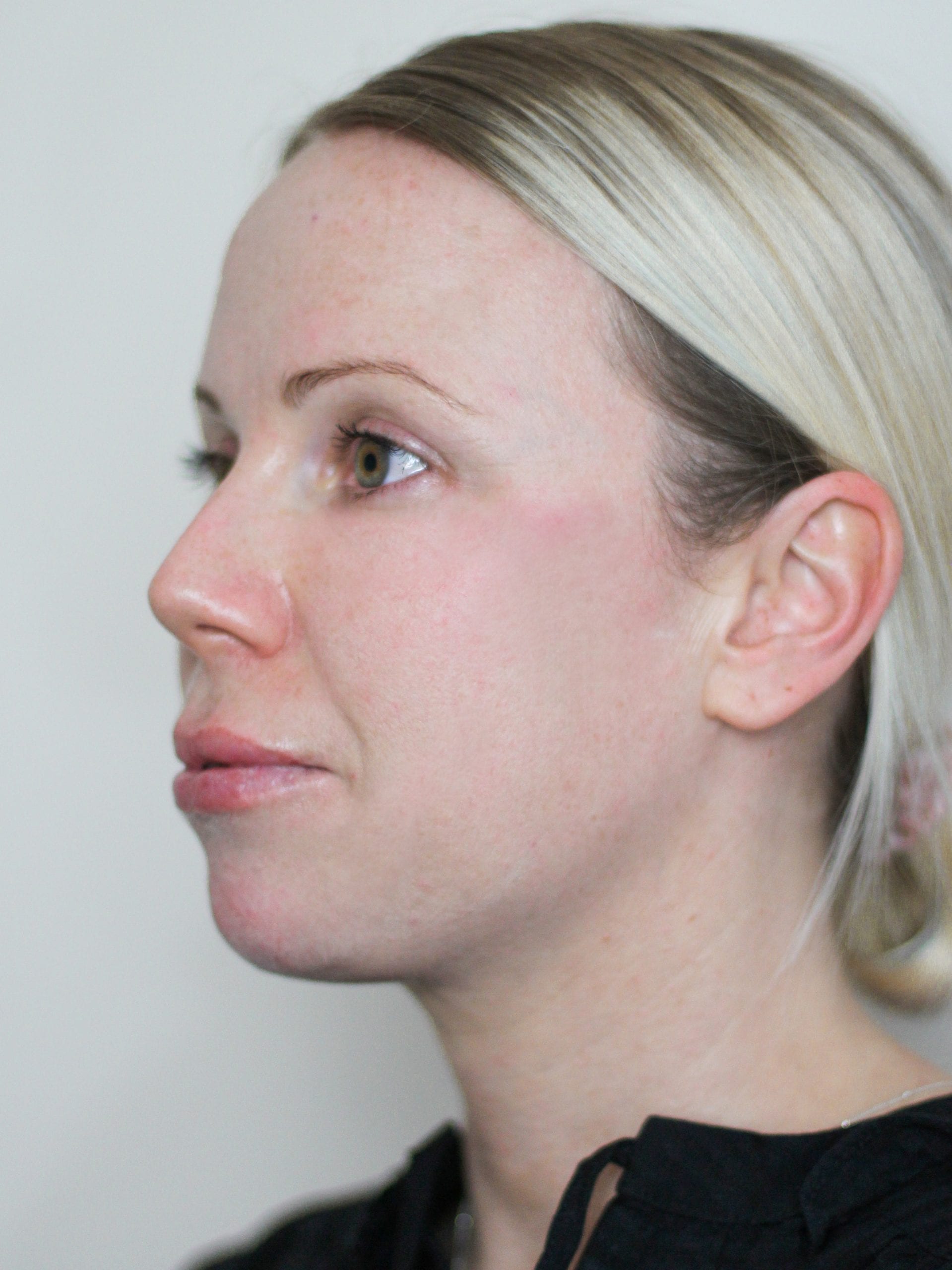 After Chin fillers treatment