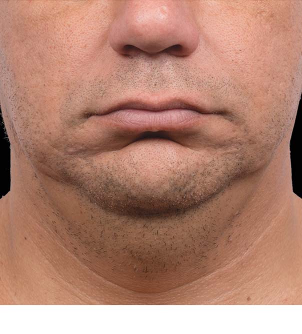A man's chin and neck after CoolMini treatment