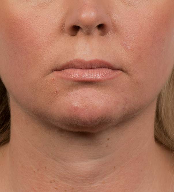 A lady's chin and neck after CoolMini treatment